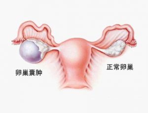 卵巢癌治疗药物鲁卡帕尼获FDA加速批准